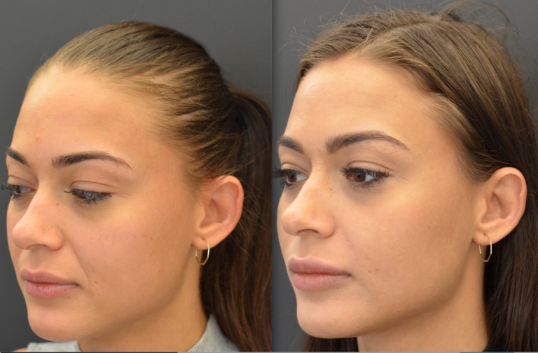 Sillons nasogéniens Docteur Schinazi