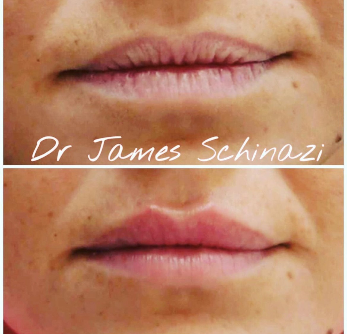 Injections des lèvres - Docteur Schinazi