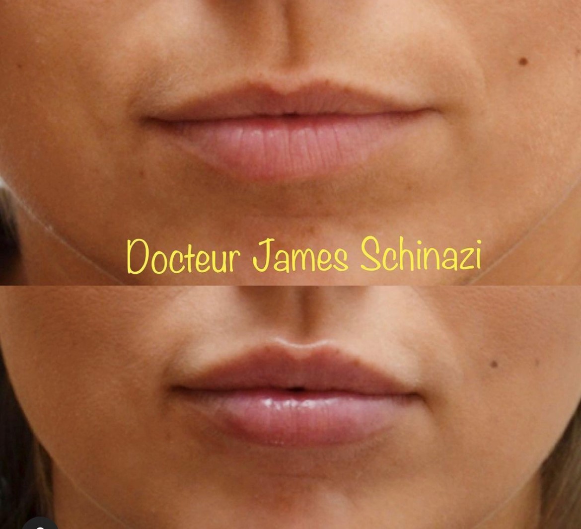 Injections des lèvres - Docteur Schinazi